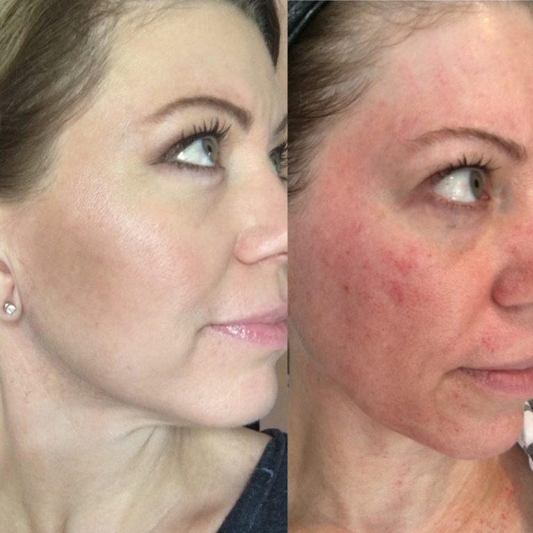 Microneedling vs Microdermabrasion vs Dermaplaning Results